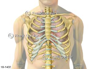 Notfall doppelter Rippenbruch Rippenfraktur, schmerzhafter Bruch oder Riss der Rippen