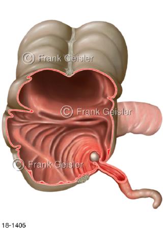 Notfall Entzündung Blinddarm Appendizitis Darm