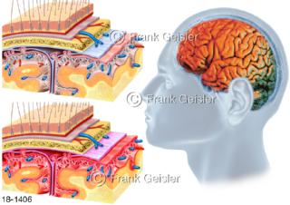 Meningitis Hirnhautentzündung, Entzündung der Hirn- oder Rückenmarkshäute