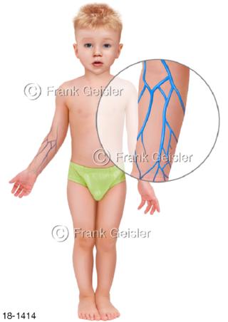 Intravenöser iv Zugang bei Kind Knabe