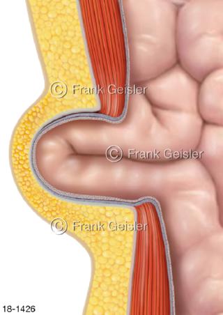 Nabelbruch Hernia umbilicalis Umbilicalhernie 