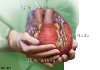 Notfallmedizin, Hand mit Spenderherz für Herztransplantation HTX Organtransplantation