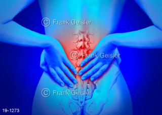 Medical-Art Rücken Rückenschmerzen Lendenwirbelsäule 