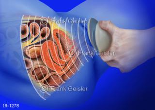 Medical-Art Organe Bauchraum Frau, Ultraschall in Gynäkologie