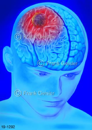Medical-Art Kopf Gehirn Hirntumor Gehirntumor