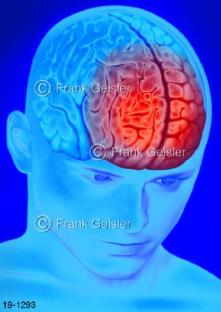 Medical-Ar Kopf Kopfschmerz Migräne