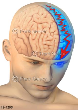 Medical-Art Kopf Kopfschmerz Migräne einseitiger Schmerz