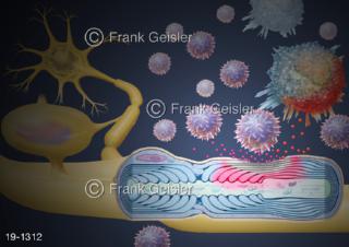 Medical-Art Multiple Sklerose MS Autoimmunskrankheit T-Zellen Monozyt Myelin