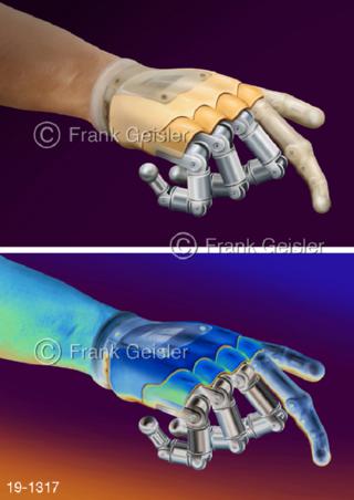 Medical-Art Bionik Hand Handprothese