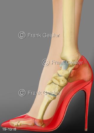 Medical-Art Fuß Fußknochen Zehen High Heel