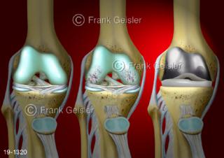 Medical-Art Kniegelenk Kniearthrose Gonarthrose Knieprothese