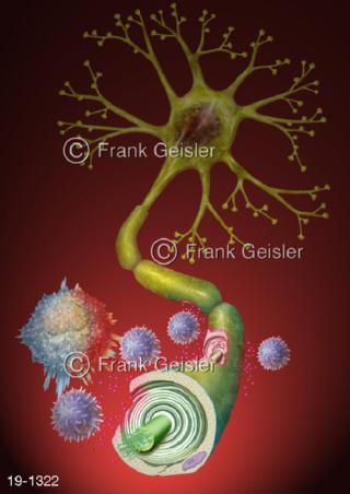 Medical-Art Neuron Markscheide Multiple Sklerose MS