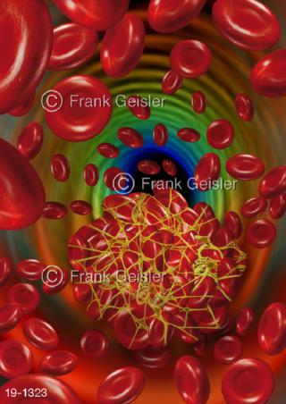Medical-Art Blut Blutgerinnsel Thrombus Blutzellen Blutkörperchen