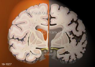 Medical-Art Gehirn Hirnschnitt Alzheimer Krankheit Demenz