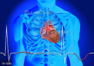 Medical-Art Herz EKG bei Takotsubo Stress Kardiomyopathie, Broken-Heart-Syndrom