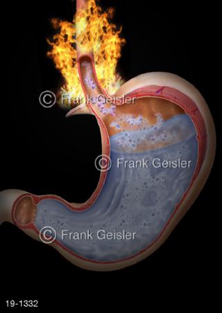 Medical-Art Magen mit Sodbrennen Reflux