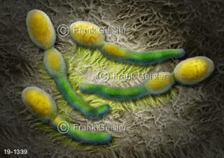 Medical-Art Kandidose Pilz Candia albicans