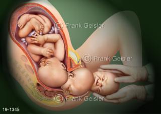 Medical-Art Baby Geburt Geburtskanal, Geburtsweg Entbindung Kind