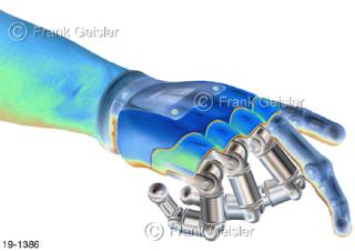 Medical-Art Bionik künstliche Hand Handprothese Roboter-Hand