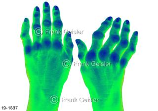 Medical-Art Hand mit rheumatoide Arthritis, Rheuma entzündliche degenerative Erkrankung 