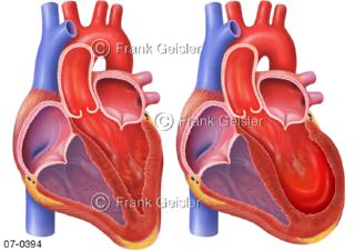 Herz bei Takotsubo-Kardiomyopathie Stresskardiomyopathie