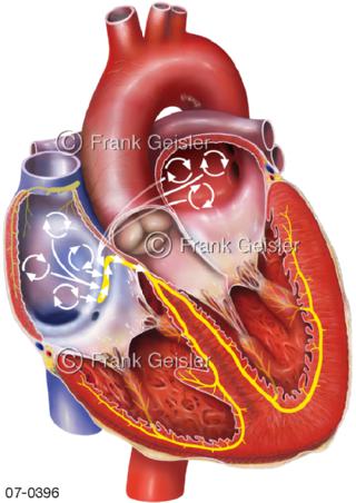 Herz, Herzrhythmusstörung Vorhofflimmern