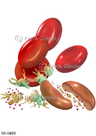 Zersetzung Blutkörperchen Erythrozyten in Milz