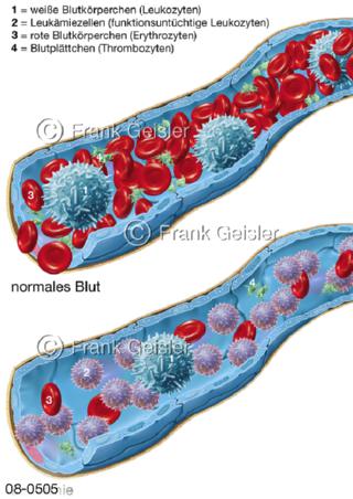 Blutzellen bei Blutkrebs Leukämie