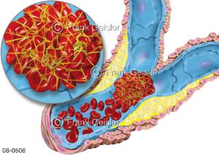 Blut mit Thrombus, systemische Embolisation Blutgerinnsel