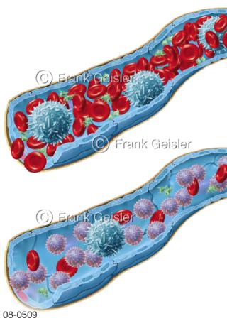 Blutzellen bei Blutkrebs Leukämie