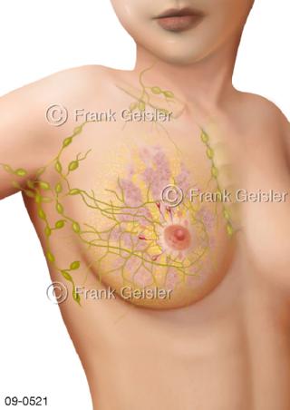  Brust Brustgewebe mit Lymphgefäße Lymphknoten