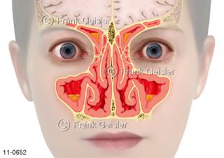 Gesicht mit Ansichten Nasenhöhle Nasennebenhöhlen Stirnhöhle, Entzündung Sinusitis
