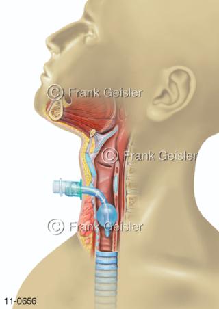 Atemtrakt Trachea, Luftröhrenschnitt Tracheotomie