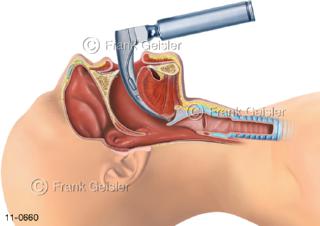 Laryngoskop, Intubation Larynx Kehlkopf