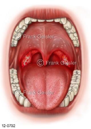 Mund Rachen mit Mandelentzündung Tonsillitis