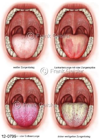 Mund mit Zunge, Diagnostik Zungenbelag