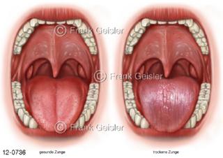 Mund mit Zunge, Diagnostik Zungenbelag, Beläge der Zunge können auf Erkrankungen hinweisen