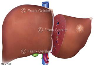 Resektion Leber bei Leberkrebs Lebertumor, chirurgischer Eingriff bei dem ein Teil der Leber entfernt wird