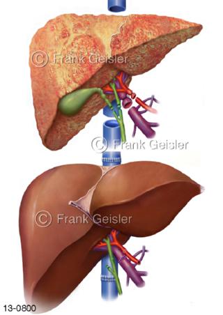Leber Hepar, Transplantation Lebertransplantation LTX