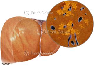 Erkrankung Leber Hepar, Fettleber Steatosis hepatis eine häufige Erkrankung