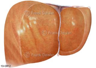 Erkrankung Leber Hepar, Fettleber Steatosis hepatis eine häufige Erkrankung