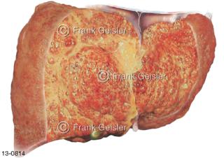 Leberzirrhose, Erkrankung Leber Hepar, Endstadium chronischer Lebererkrankungen