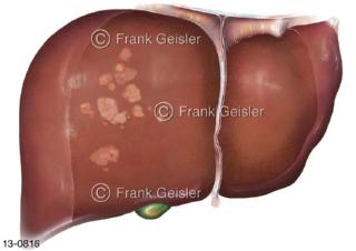 Lebertumore Leberkrebs Leber mit Hepatozelluläres Karzinom, ein seltener schwerwiegender Tumor