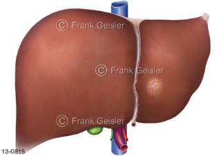 Verdauungsorgan Leber Hepar mit Lebererkrankung Leberkrebs Leberkarzinom