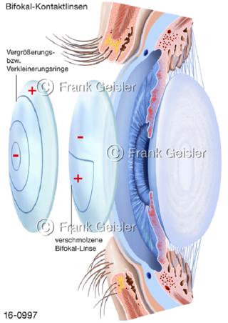Auge Augenlinse Kontaktlinsen