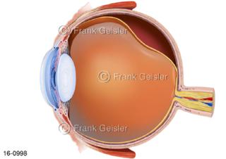 Sinnesorgan Auge, Augapfel mit Glaskörper Glaskörperabhebung 