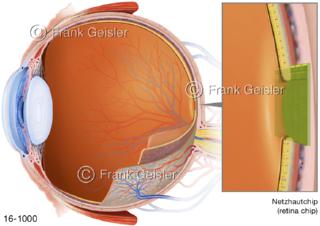 Sehorgane Auge Augapfel, Netzhautchip Retina-Implantat eine bionische Prothese