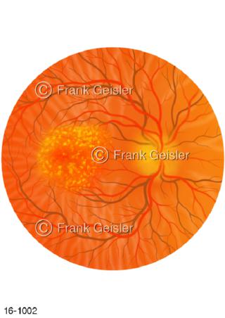 Augenhintergrund Makula trockene Makuladegeneration