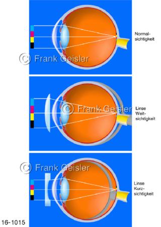 Fehlsichtigkeit Augen, Linse weitsichtig kurzsichtig