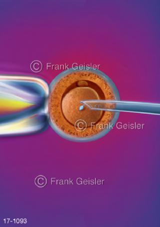 Fortpflanzung, In-​Vitro-Fertilisation IVF